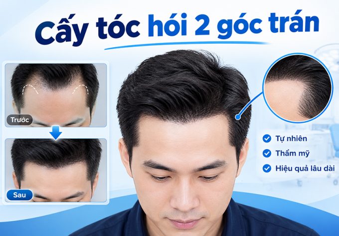 Cấy tóc hói 2 góc trán: Giải pháp lấy lại đường chân tóc đầy đặn, tự nhiên