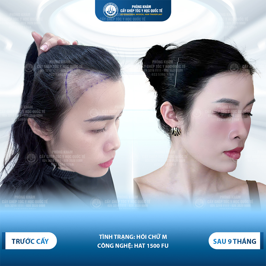 cấy tóc tự thân