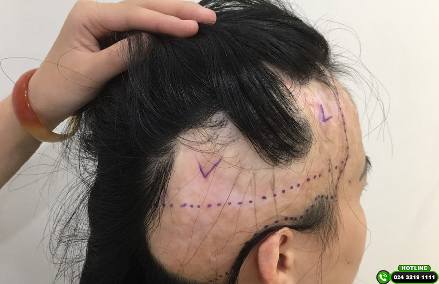 cấy tóc vào sẹo bỏng có được không-1