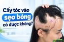 Cấy tóc vào sẹo bỏng có được không? 5 yếu tố quyết định khả năng mọc tóc