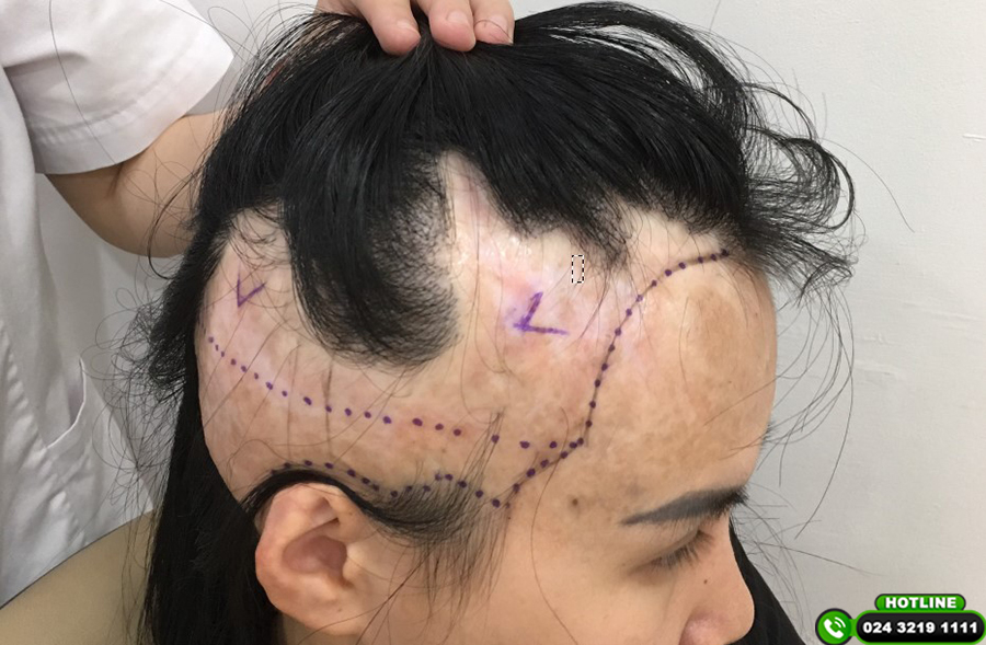 cấy tóc vào sẹo bỏng có được không-1