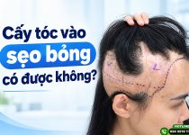 cấy tóc vào sẹo bỏng có được không