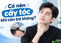 có nên cấy tóc khi còn trẻ không