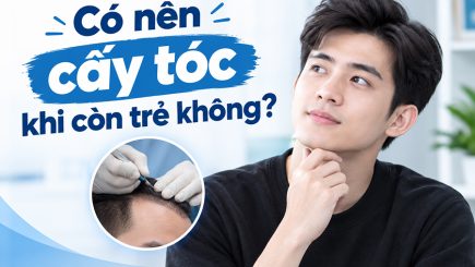 có nên cấy tóc khi còn trẻ không