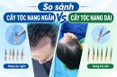 Cấy tóc nang ngắn vs cấy tóc nang dài: So sánh từ kỹ thuật tới hiệu quả