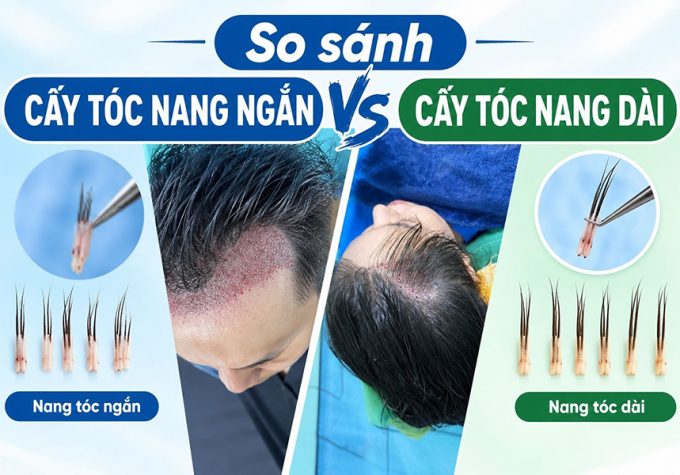 Cấy tóc nang ngắn vs cấy tóc nang dài: So sánh từ kỹ thuật tới hiệu quả
