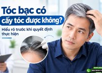 Tóc bạc có cấy tóc được không?