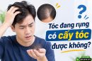 Tóc đang rụng có cấy tóc được không? Đừng vội quyết định nếu chưa biết điều này