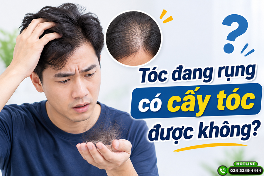 Tóc đang rụng có cấy tóc được không? Đừng vội quyết định nếu chưa biết điều này
