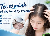 tóc tơ mảnh có cấy tóc được không