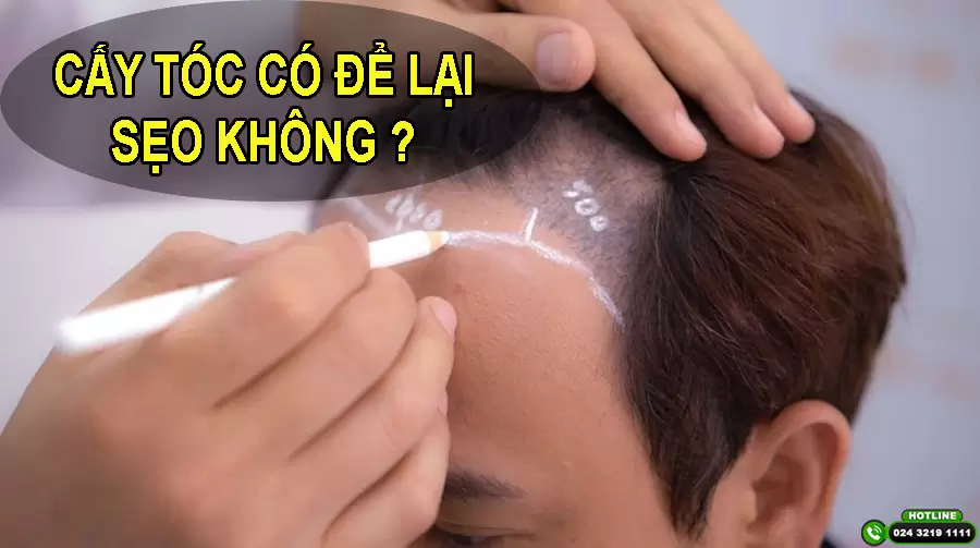 [GIẢI ĐÁP VẤN ĐỀ] : CẤY TÓC CÓ ĐỂ LẠI SẸO KHÔNG?