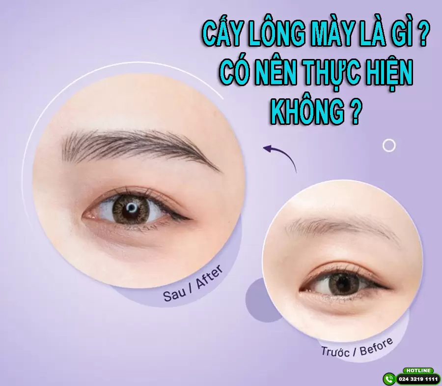 Cấy lông mày tự thân là gì và có nên thực hiện không?