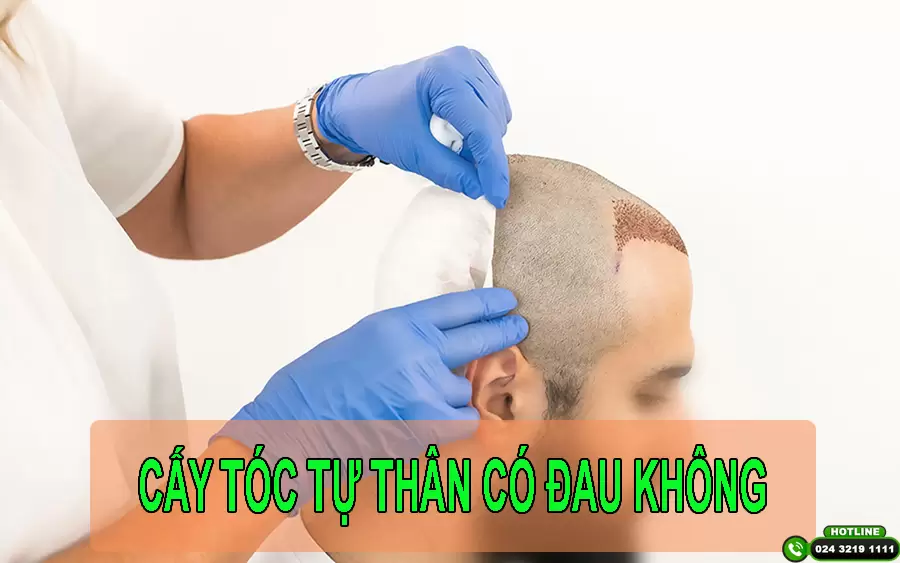Cấy tóc tự thân có đau không và lưu ý khi chăm sóc hậu phẫu