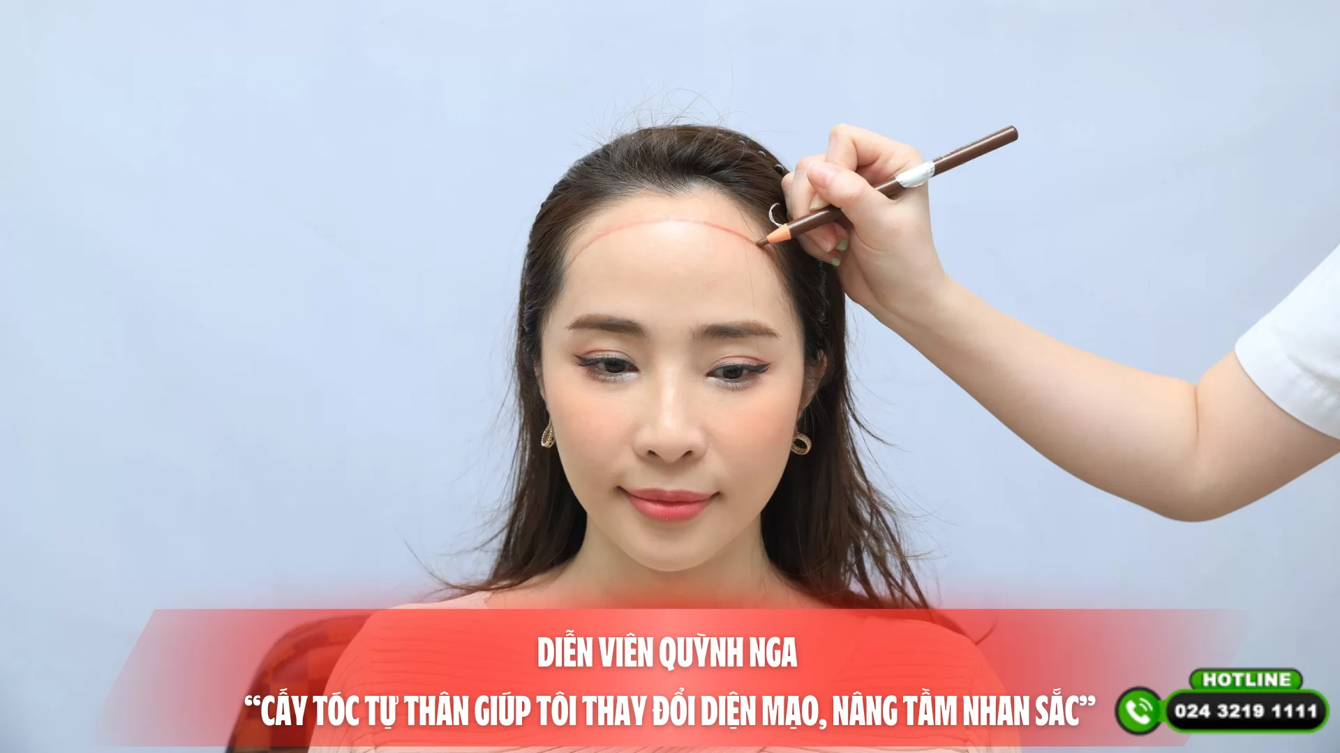 Diễn viên Quỳnh Nga “Cấy tóc tự thân giúp tôi thay đổi diện mạo, nâng tầm nhan sắc”