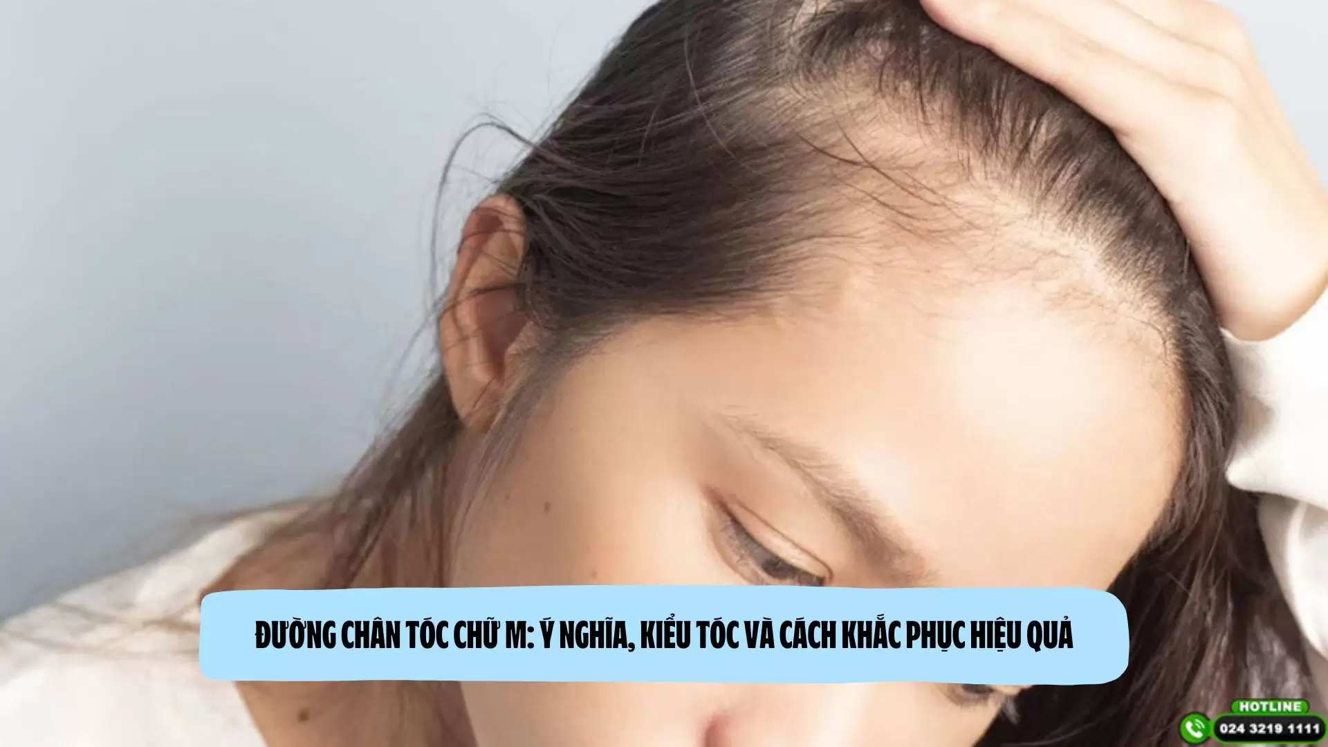 Đường chân tóc chữ M: ý nghĩa, kiểu tóc và cách khắc phục hiệu quả