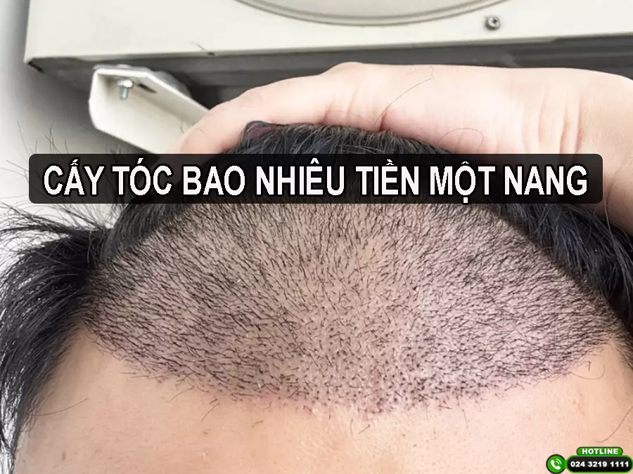 Cấy tóc bao nhiêu tiền một sợi? Bảng giá chi tiết