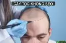 Cấy tóc không sẹo: Lựa chọn thông minh cho người hói đầu