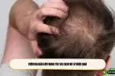 Viêm da đầu gây rụng tóc và cách xử lý hiệu quả