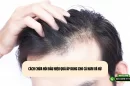 Cách chữa hói đầu hiệu quả áp dụng cho cả nam và nữ