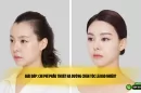 Giải đáp: Chi phí phẫu thuật hạ đường chân tóc là bao nhiêu?
