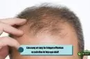 Cẩm nang về rụng tóc telogen effluvium và cách điều trị hiệu quả nhất!