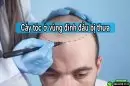 Cấy tóc ở vùng đỉnh đầu bị thưa: Quy trình, chi phí và hình ảnh thực tế