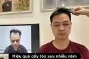 Hiệu quả của cấy tóc sau nhiều năm: Liệu có duy trì được như mong đợi?