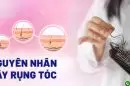 Tổng hợp các nguyên nhân tóc rụng và cách điều trị