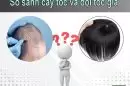 So sánh cấy tóc và đội tóc giả? Giải pháp nào ưu việt hơn?