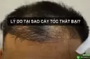Tìm hiểu lý do tại sao cấy tóc thất bại