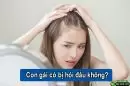Con gái có bị hói đầu không? Cách phòng tránh và khắc phục hiệu quả