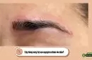 Cấy lông mày bị sẹo nguyên nhân do đâu?