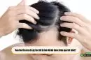 Bao lâu thì nên đi cấy tóc khi bị hói để đạt được hiệu quả tốt nhất?